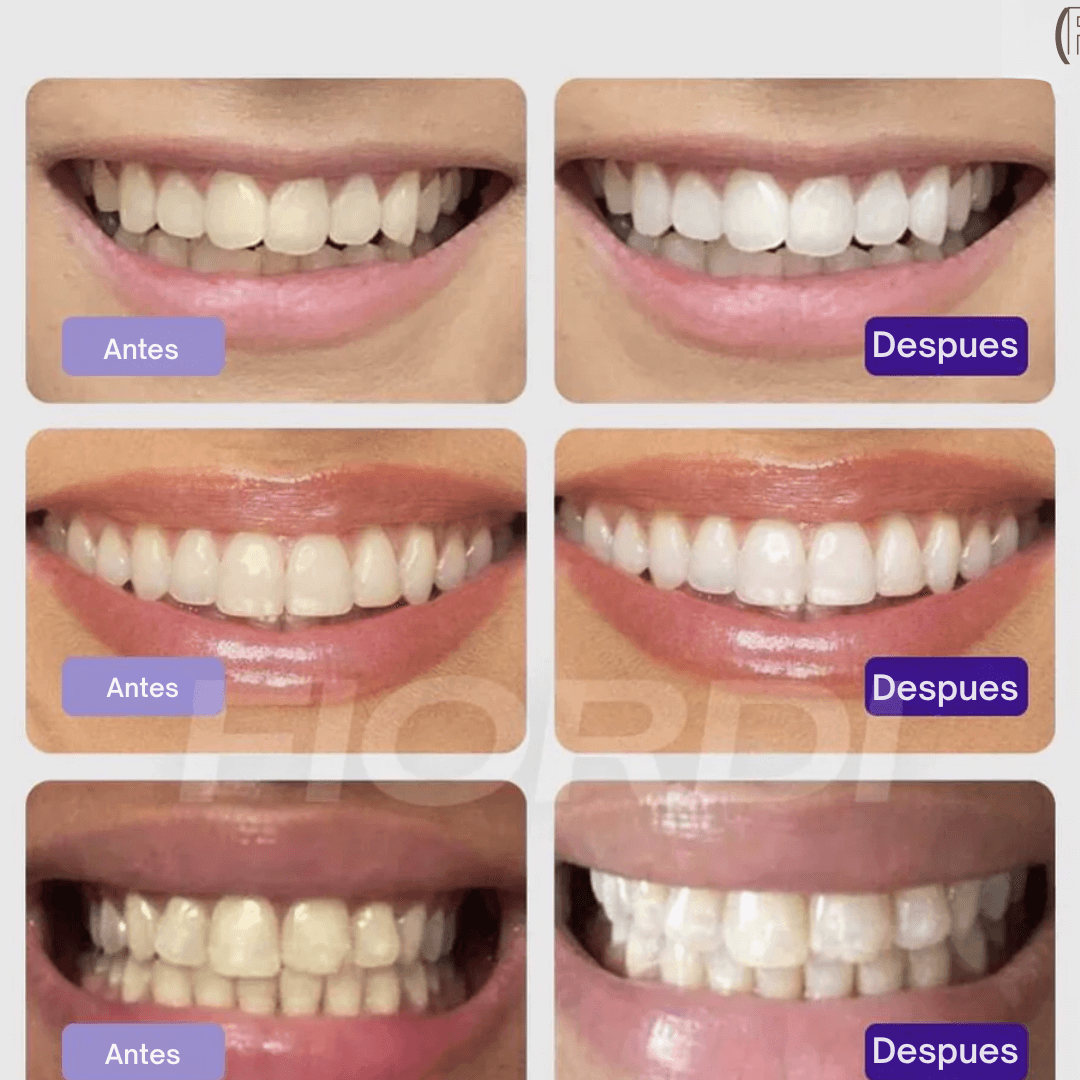 EELHOE™ – El Secreto para un blanqueo dental en solo minutos