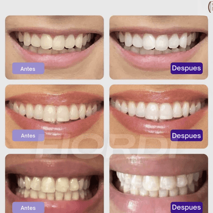 EELHOE™ – El Secreto para un blanqueo dental en solo minutos